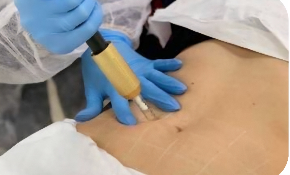 3 Session Fat Dissolving Package