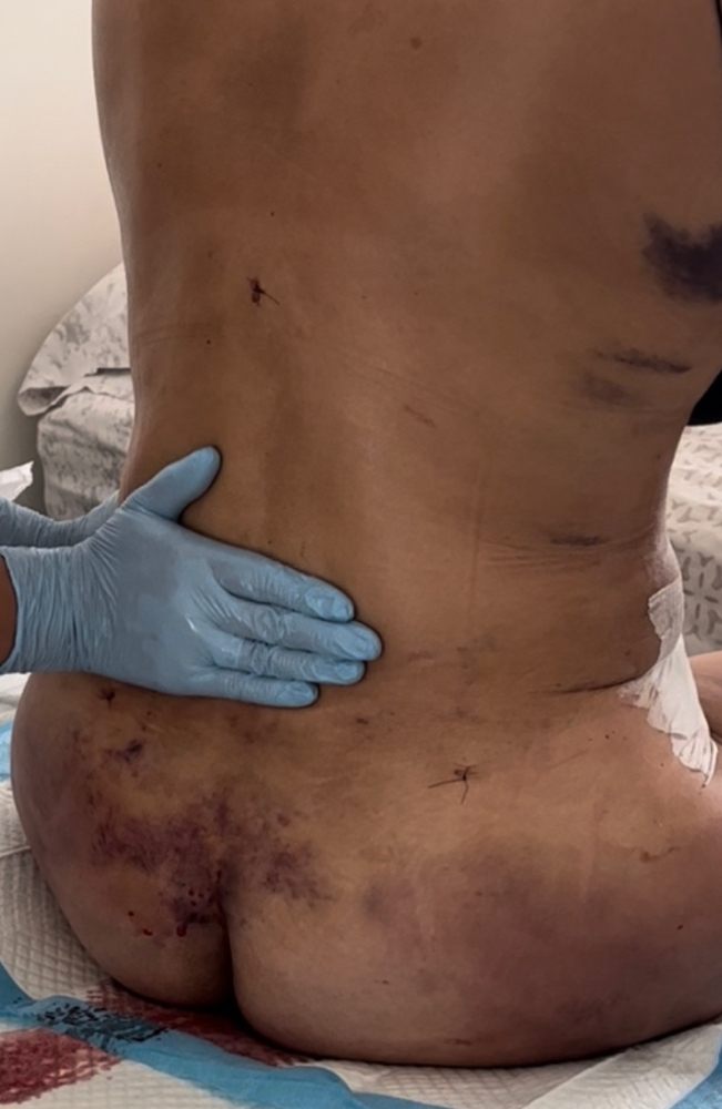 Postoperatorio Programa 10 Sesiones