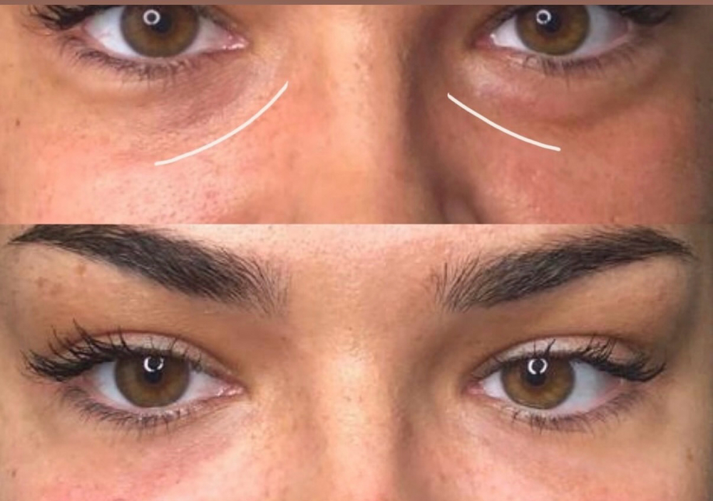 Under Eye
