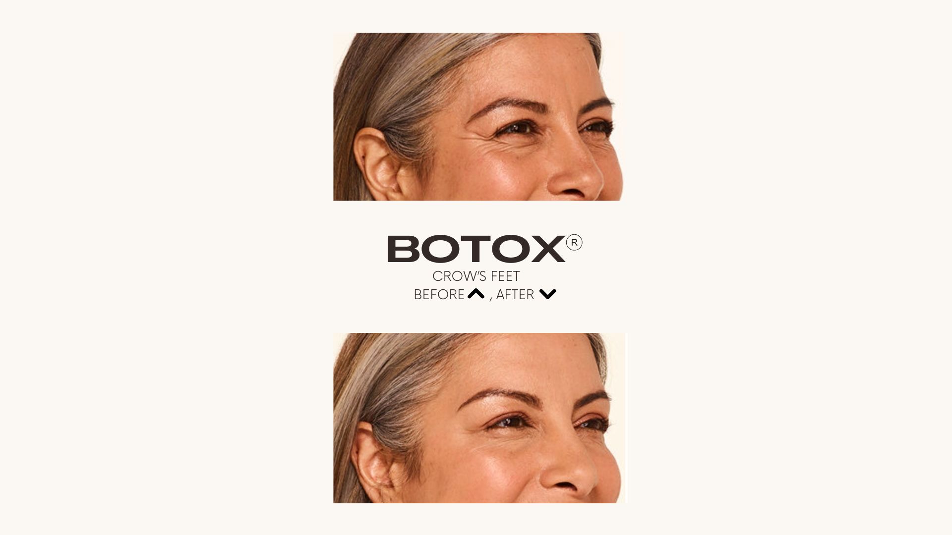 Botox®