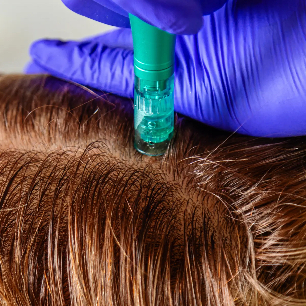 Capillary Plasma at Mila Wellness Center in Doral, FL