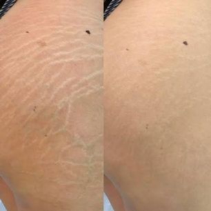 Inkless Stretch Mark Revision at Aureum Ink in San Jose, CA