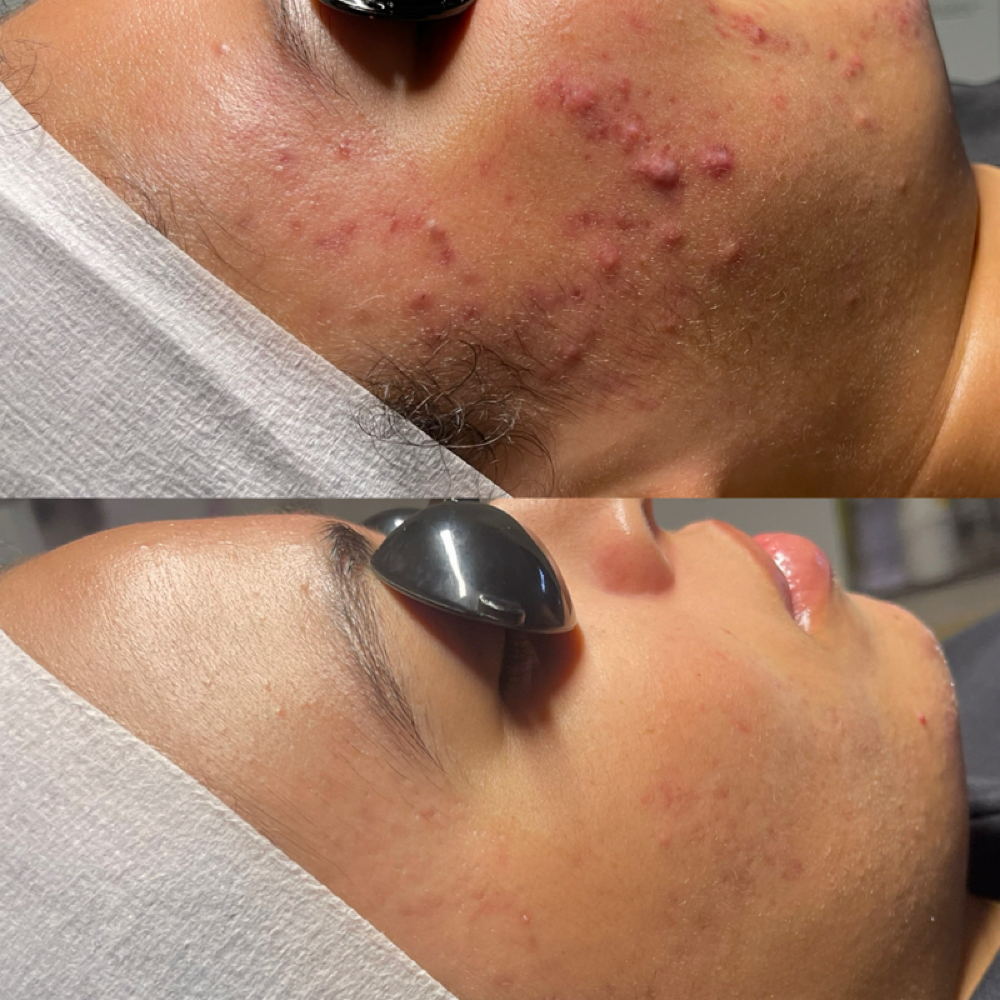 ACNE CONSULT + TREATMENT at Czerinaesthetics, LLC in San Antonio, TX
