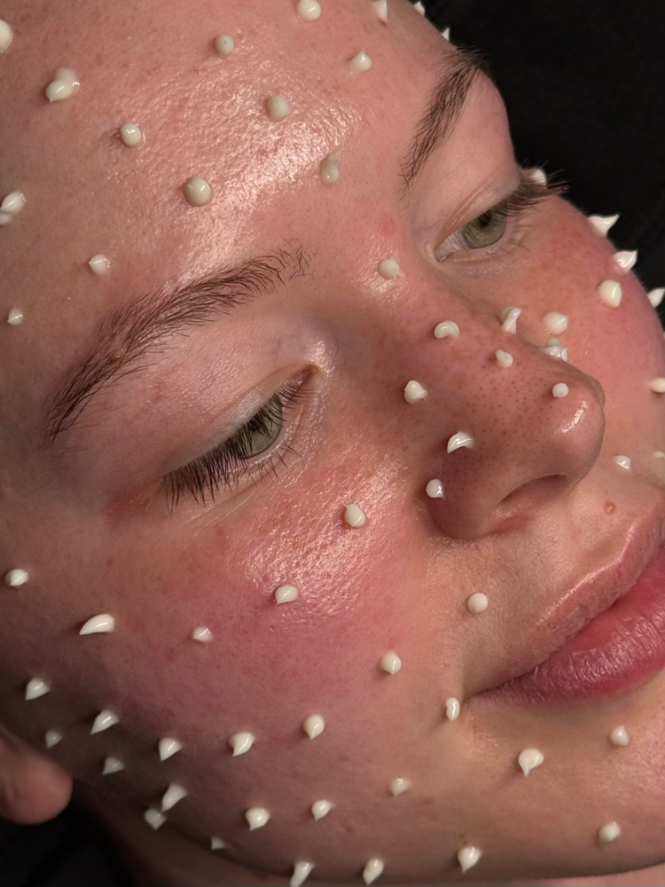 the liquid microneedling series at Butler Skin in Sheridan, WY