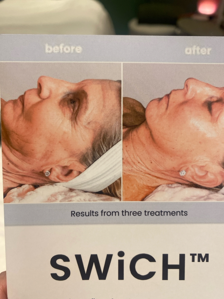 SWiCH dermal Rejuvenation