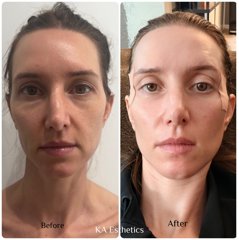 Manual Rejuvenation Intro