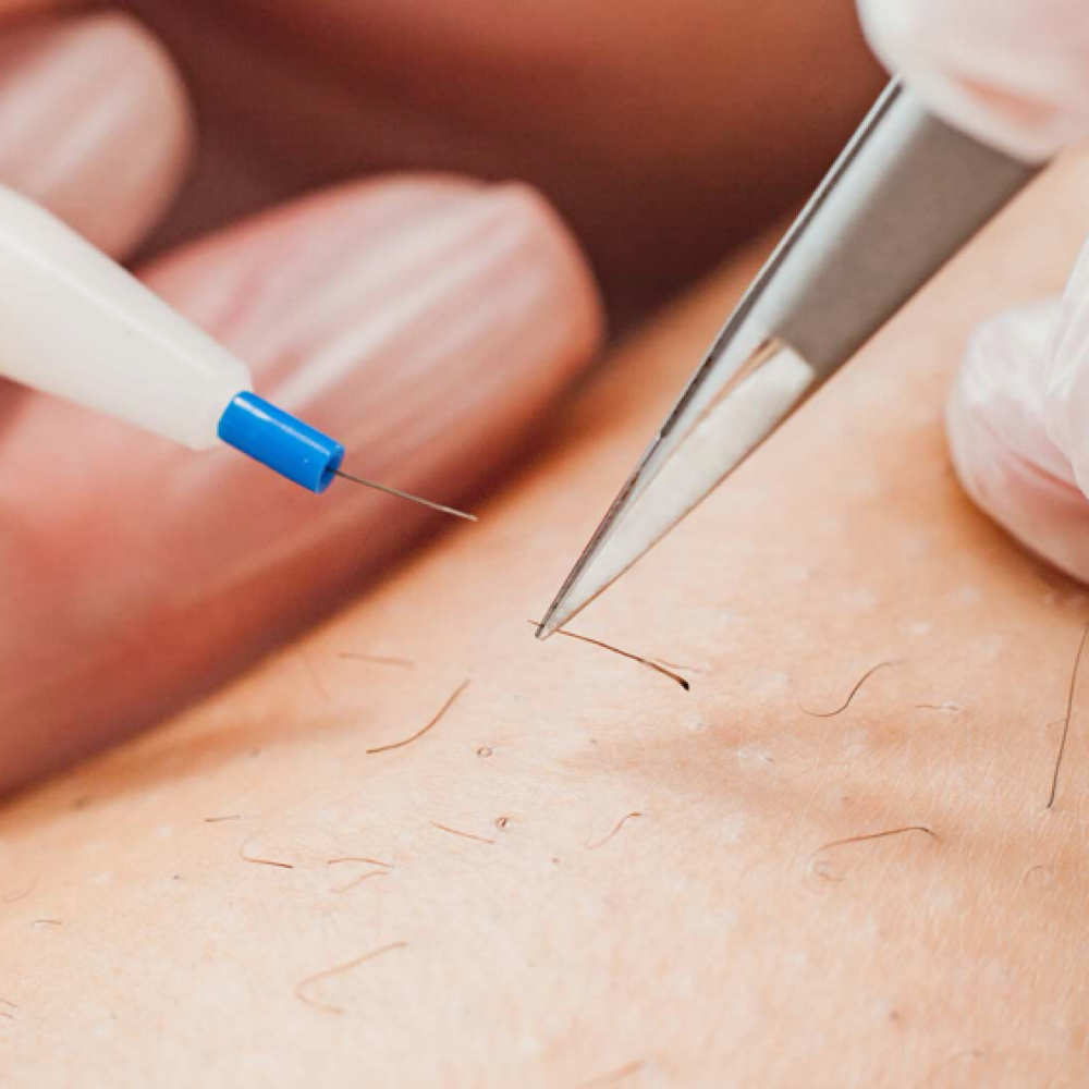 Electrolysis Consultation (Free) at Mirabella Beauty & Spa in Sarasota, FL