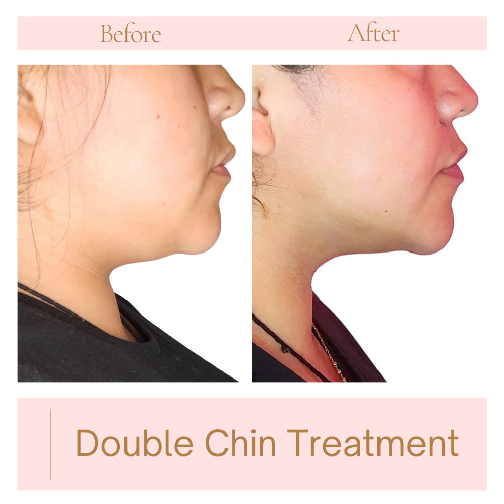 Double Chin Treatment