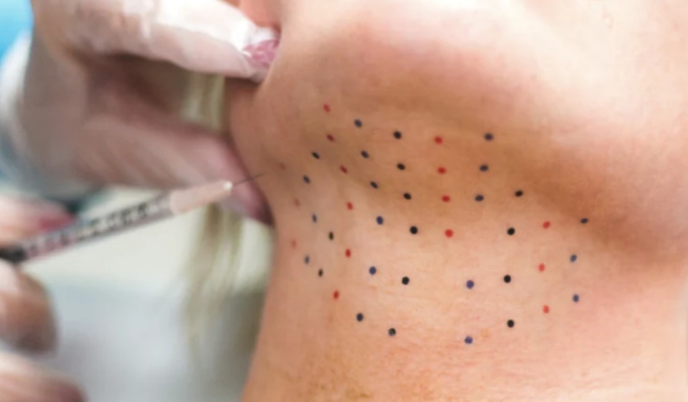 Mesotherapy aka Kybella