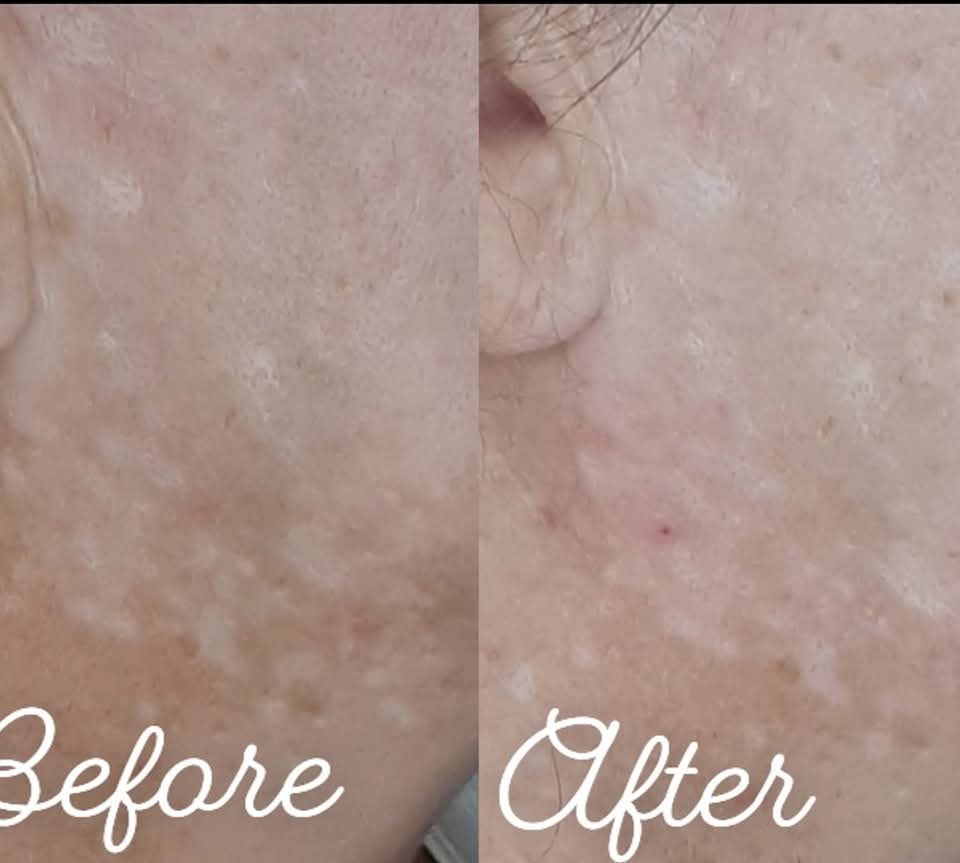 TCA Chemical Peel