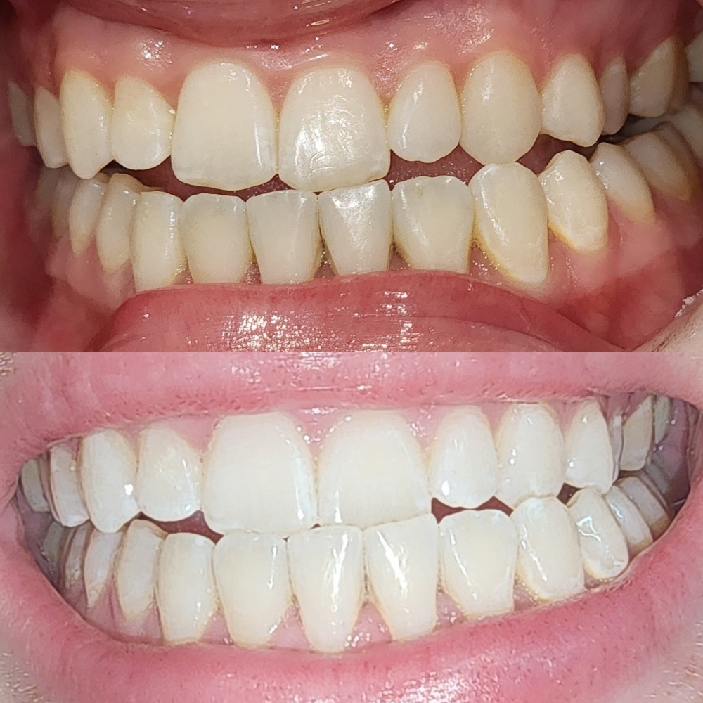 Teeth Whitening 60 min
