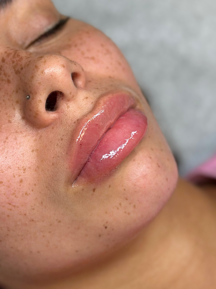 Lip Enhancement FULL session