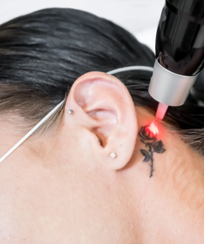 Tattoo Removal