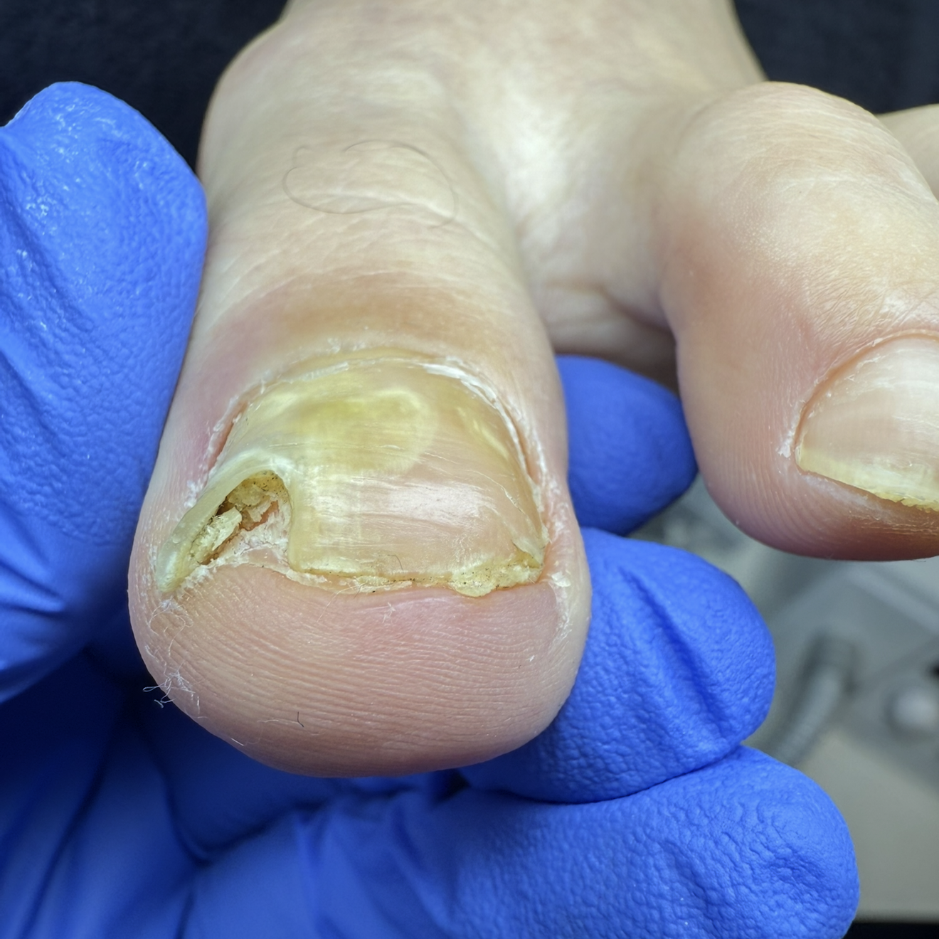 Advanced Toenail Care 4