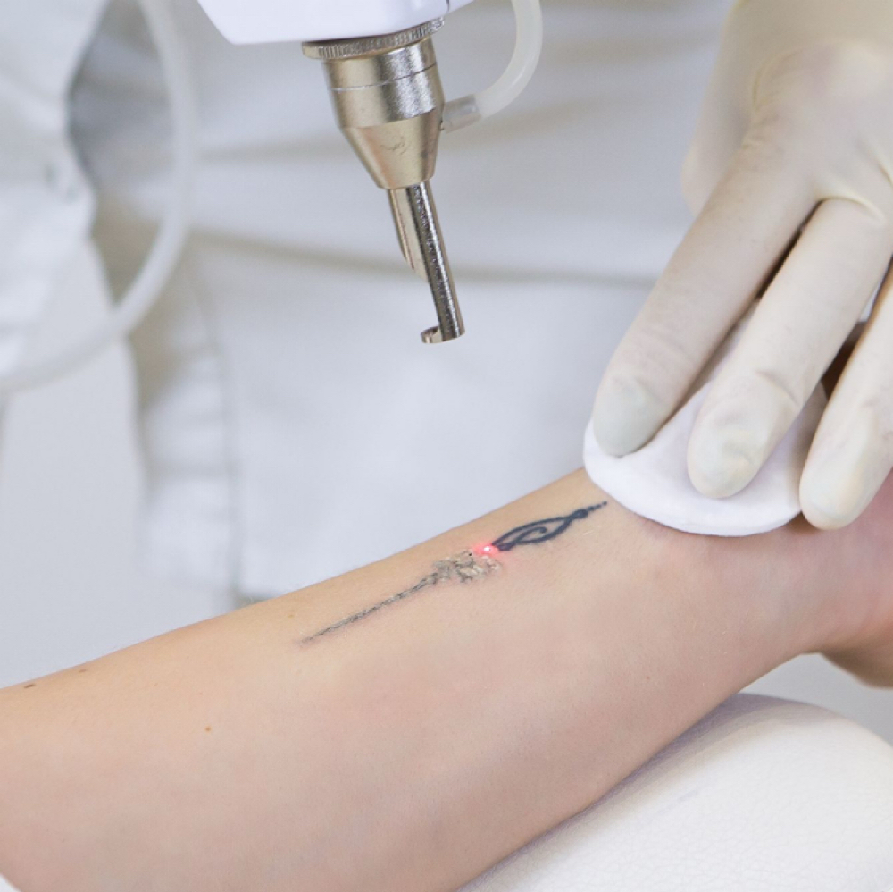 Tattoo Removal Consult at Alyssa Downs in Kennewick, WA