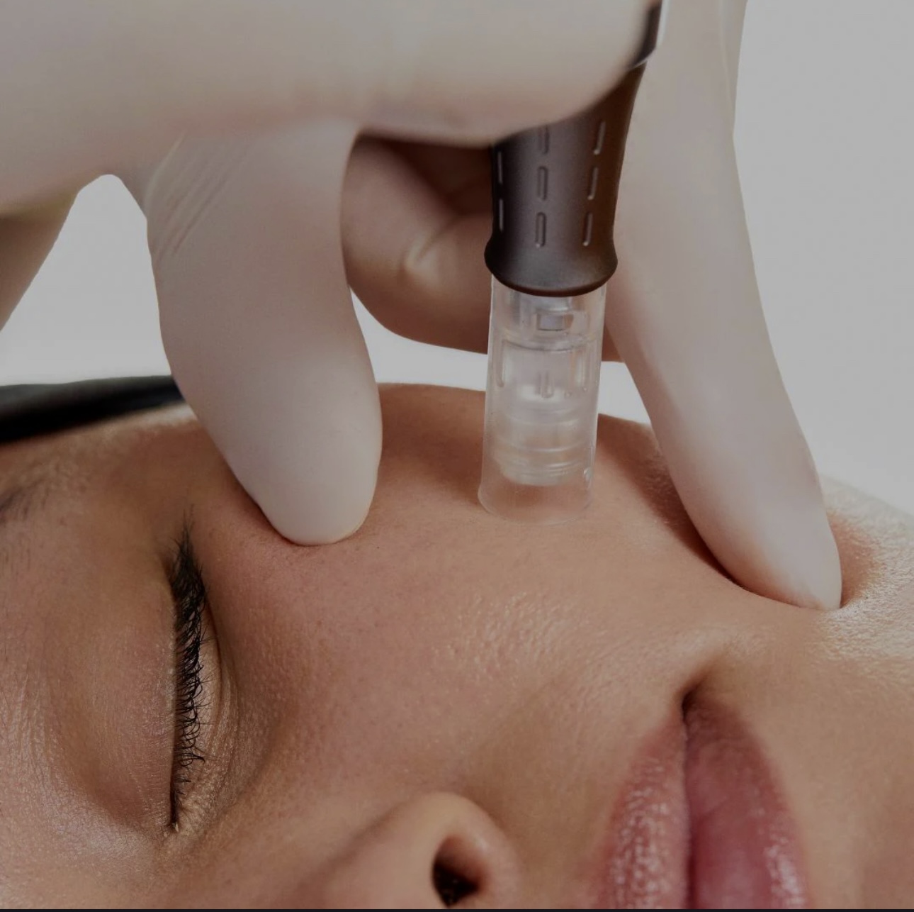 Microneedling