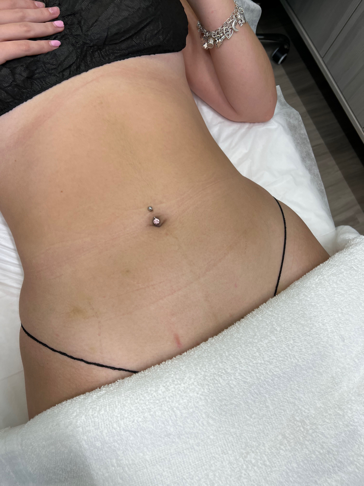 9 Sessions 360 Deluxe Lipo (45 Min)
