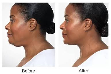 Non-Surgical Chin Lipo