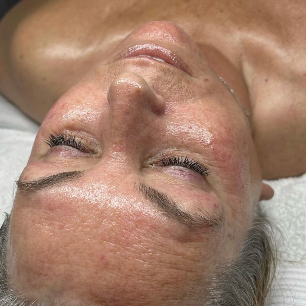 Chemical Peel Facial at Skin Alchemy in South Charleston, WV