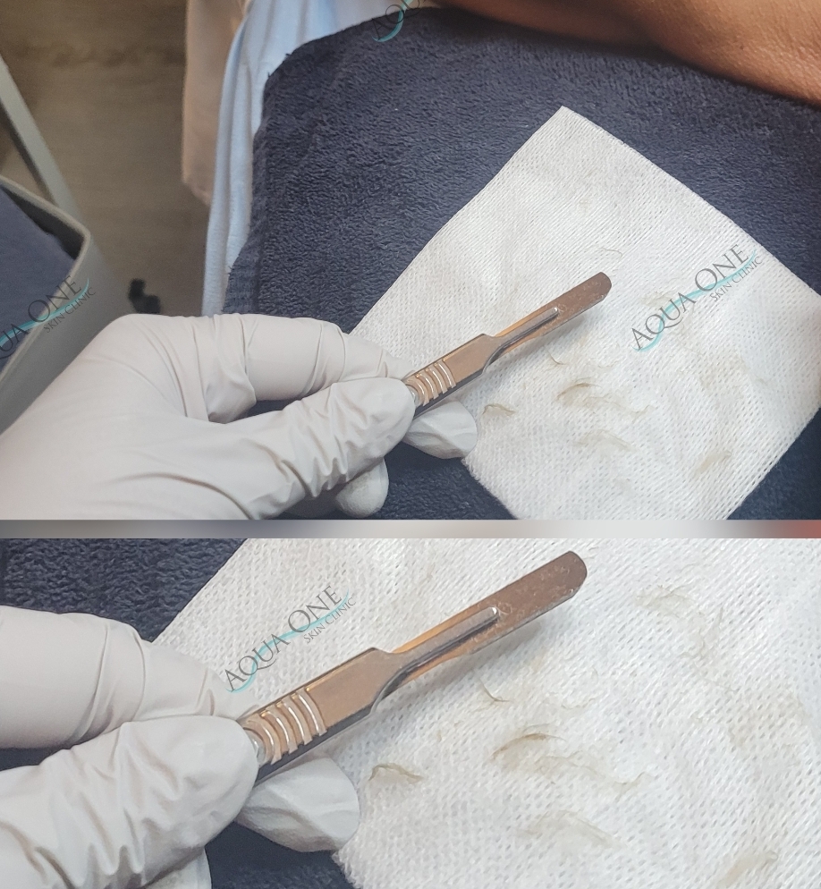 Skin Bar Dermaplane
