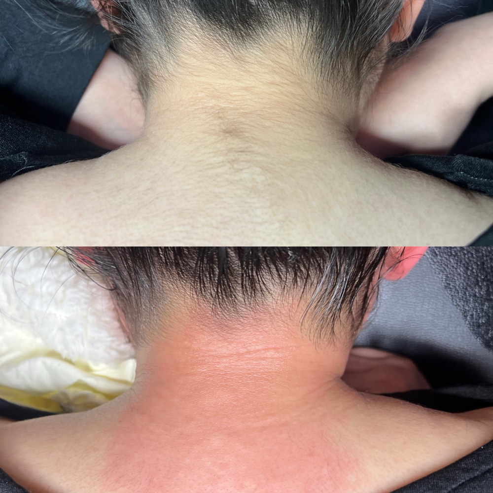 Neck/Hairline