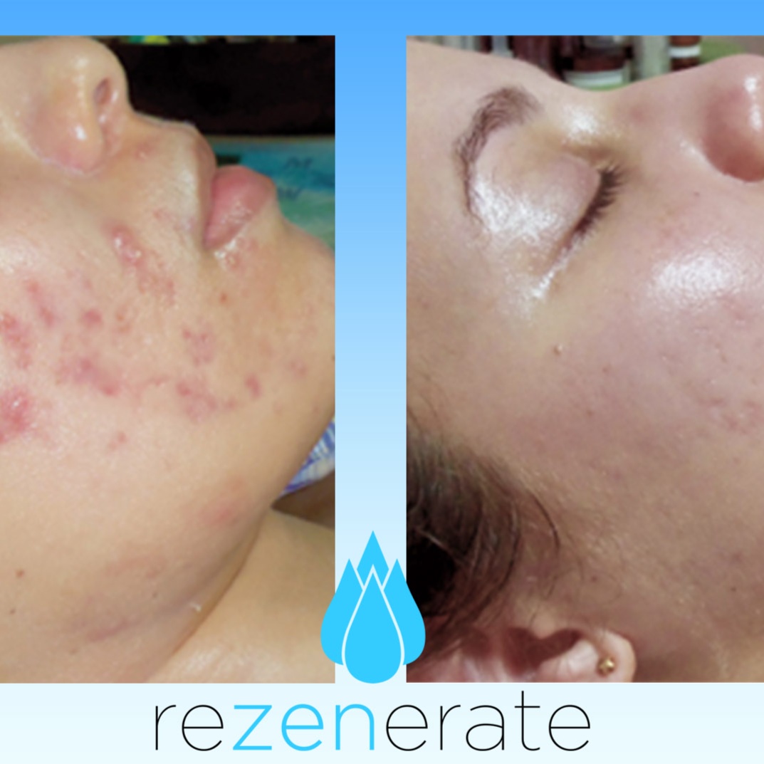 Rezenerate Nano Facial