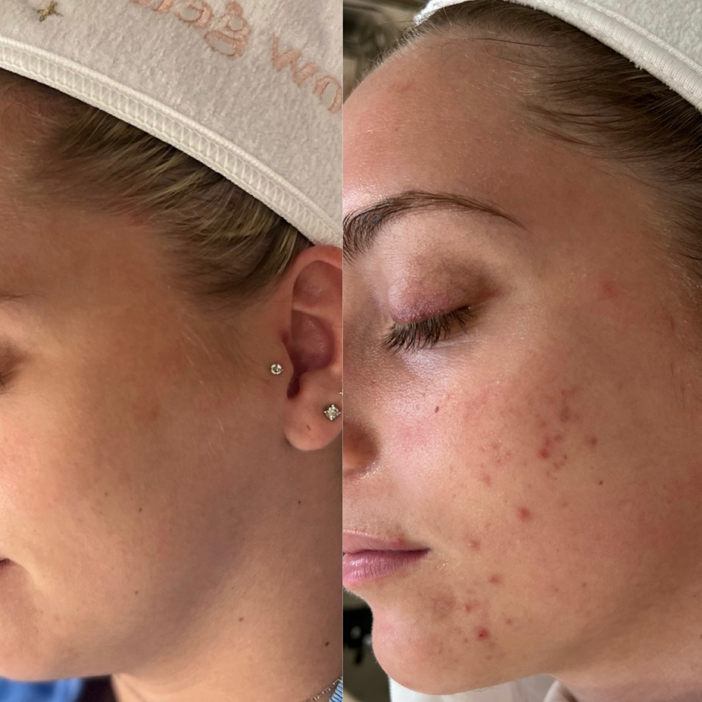 Acne Bootcamp Consult + Treatment