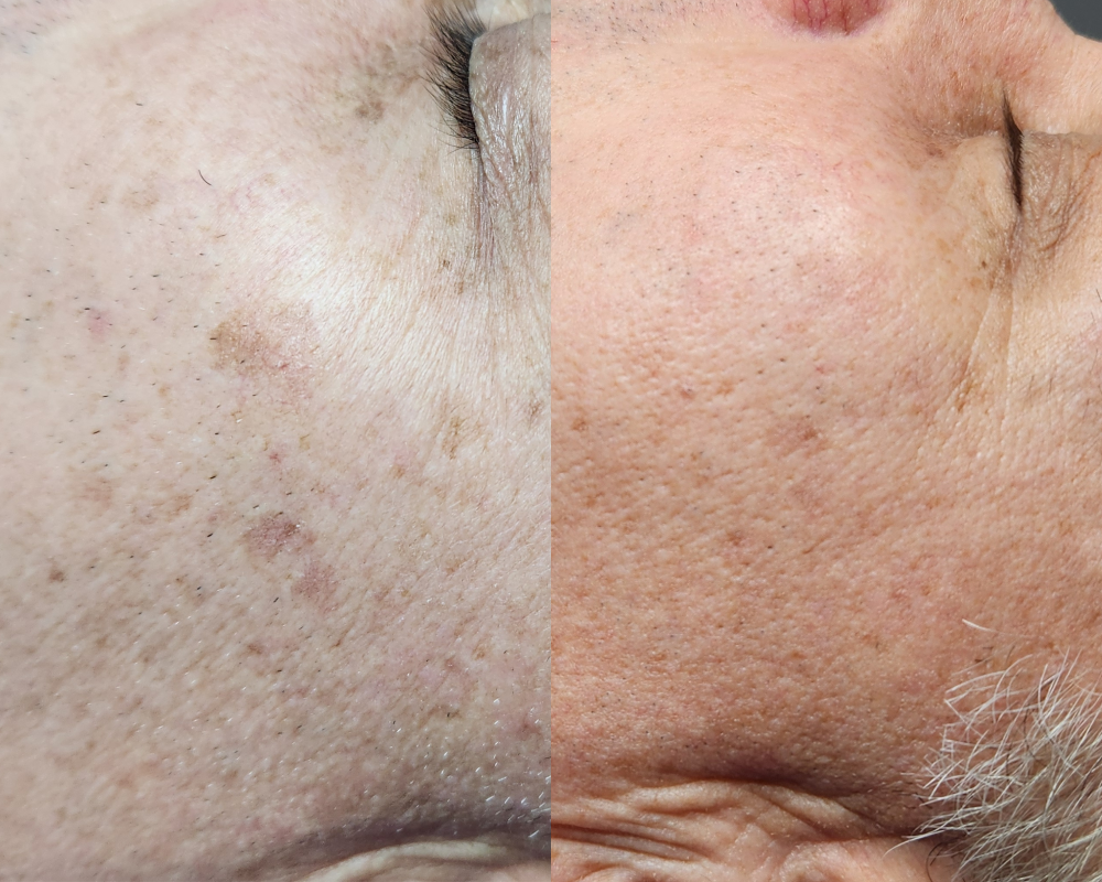 Chemical Peel