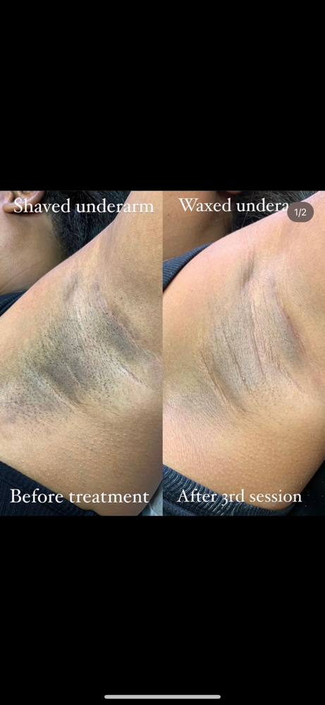 Intimate Skin Bleaching Consultaion