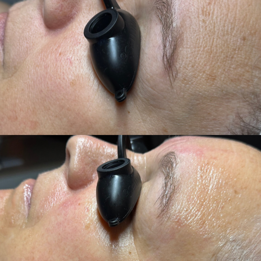 Tier 2- Advanced Custom Facial at Satin Skin Esthetics LLC in Glens Falls, NY