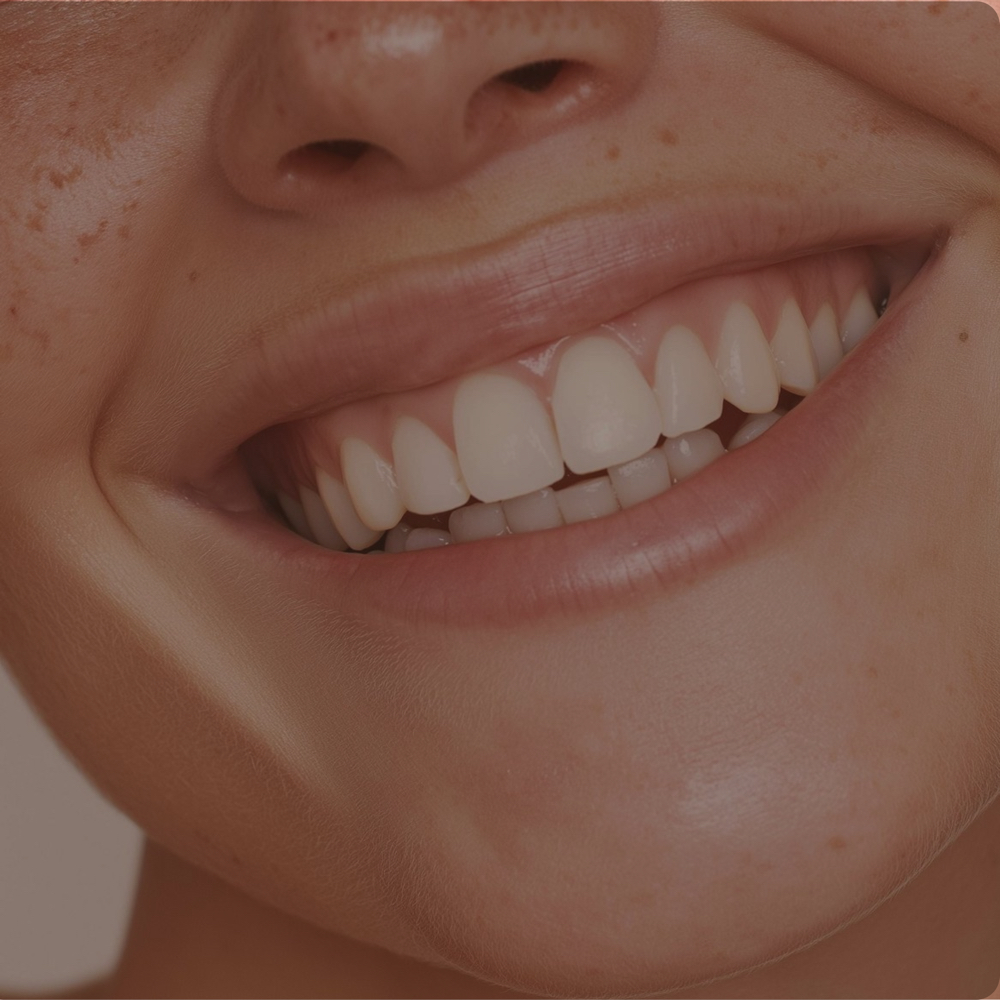 Gummy Smile Botox at SKN on Main in Dennis, MA