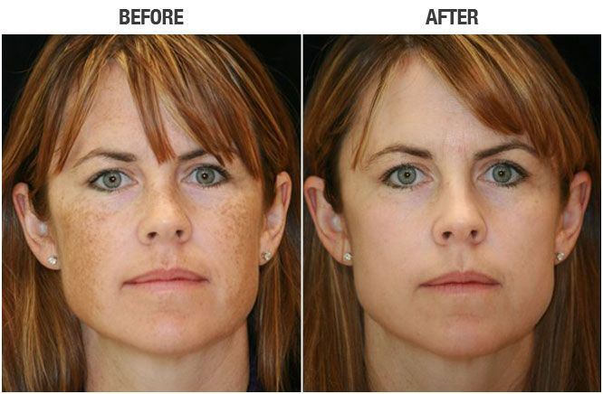 Photo Facial-IPL Lumecca