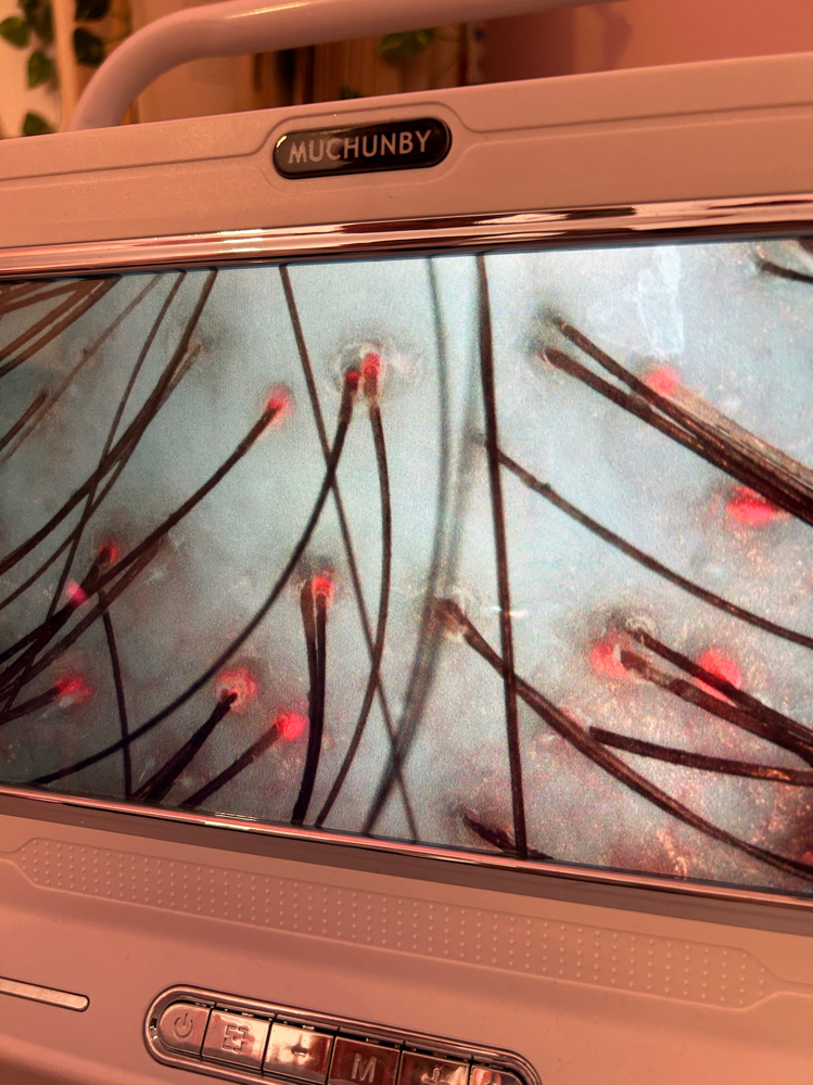 Scalp Analysis Only No Treatment