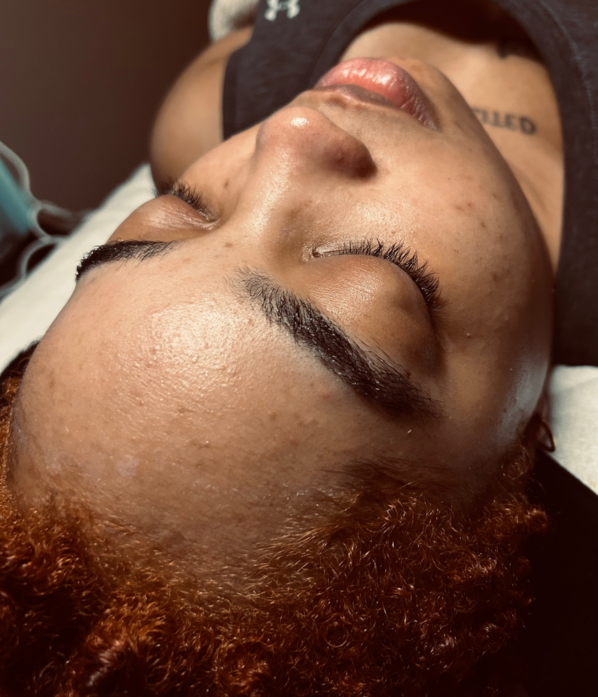 Advanced Acne Peel