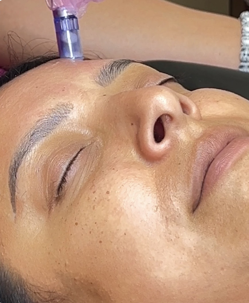 Collagen Induction LED Skin Repair at Moore Realistic in Houston, TX