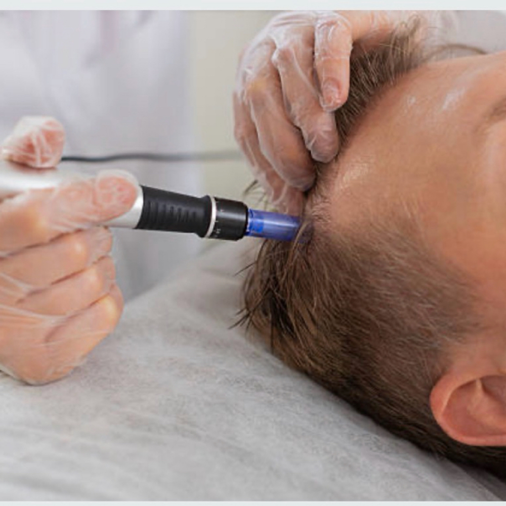 Hair Restoration Consult at SCL Aesthetics in Putnam, CT