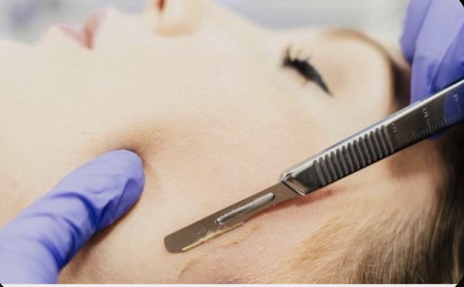 Dermaplaning