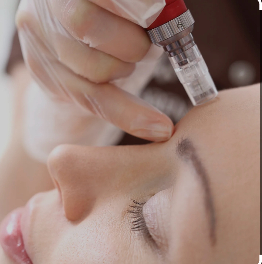 Microneedling