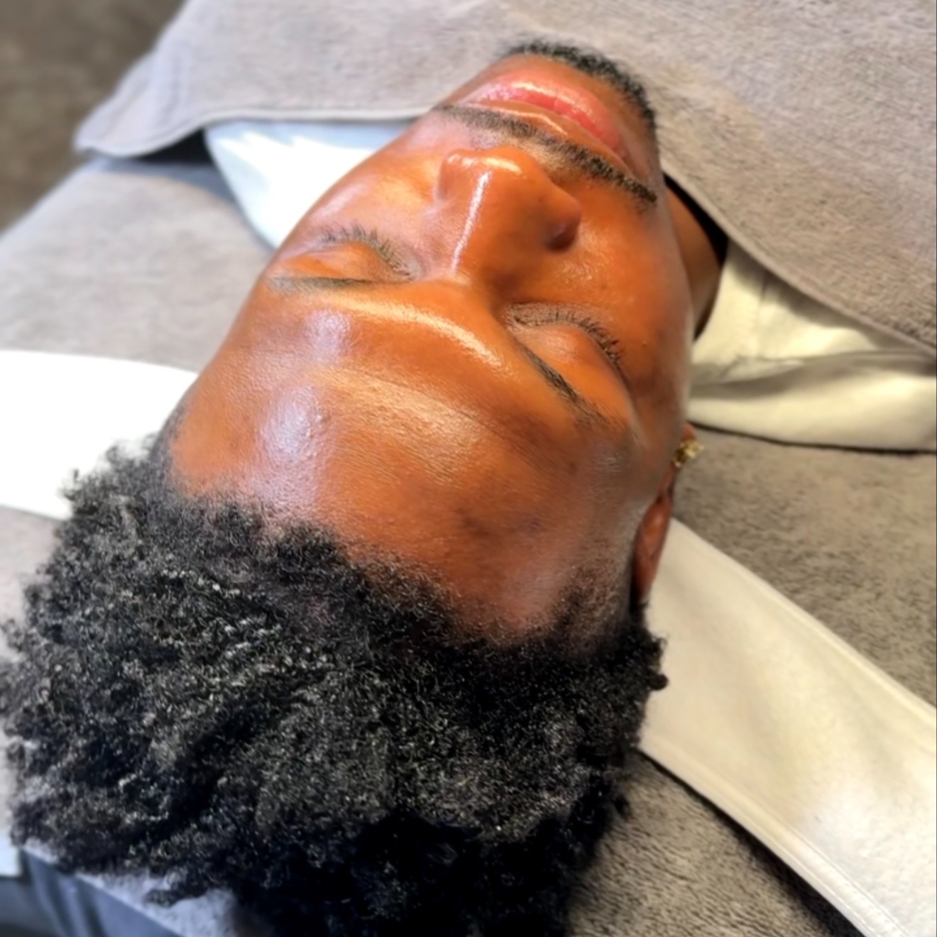 HYPERPIGMENTATION FACIAL