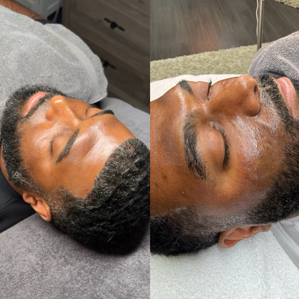 HYPERPIGMENTATION FACIAL at Blanche’s Beautiquè in Charlotte, NC