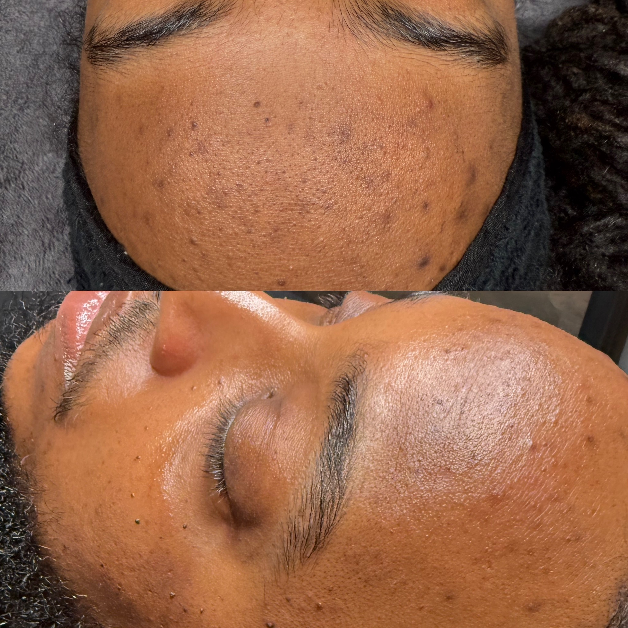 HYPERPIGMENTATION FACIAL