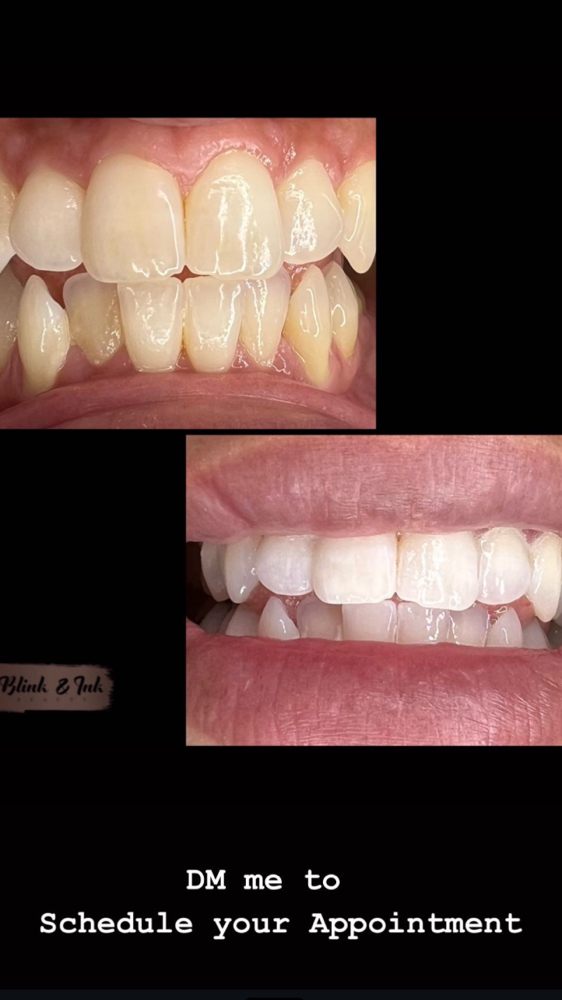 Teeth Whitening