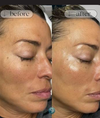 Dermaplane & enzyme Facial