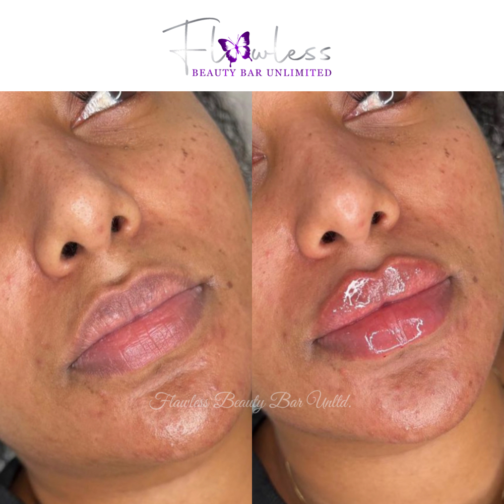 Hyaluronic Lip Fillers
