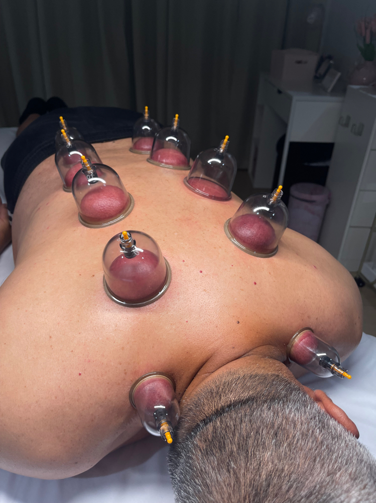 Cupping at Luxury Skin By Ash in Palm Desert, CA