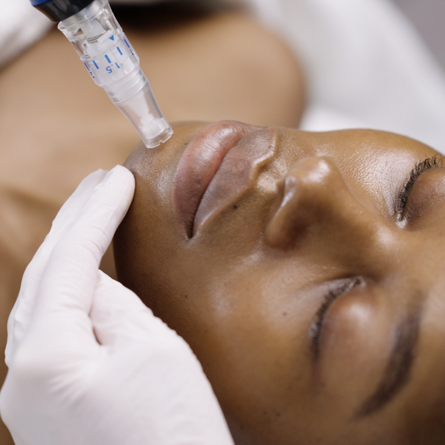Microneedling Facial at Mussa Beauty by Insam in Phoenix, AZ