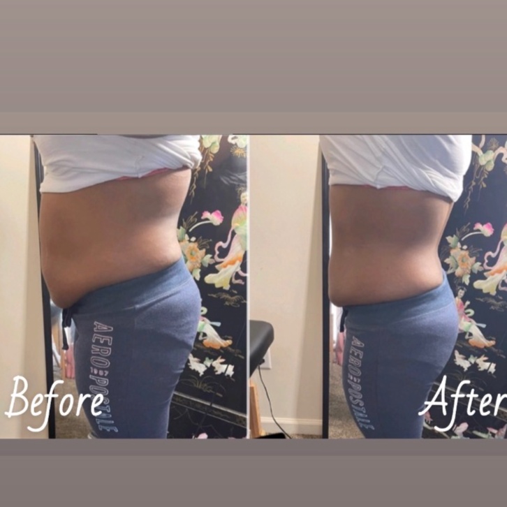 Liposuction Cavitation + S.T at Cozy Braids in SOUTHAVEN, MS