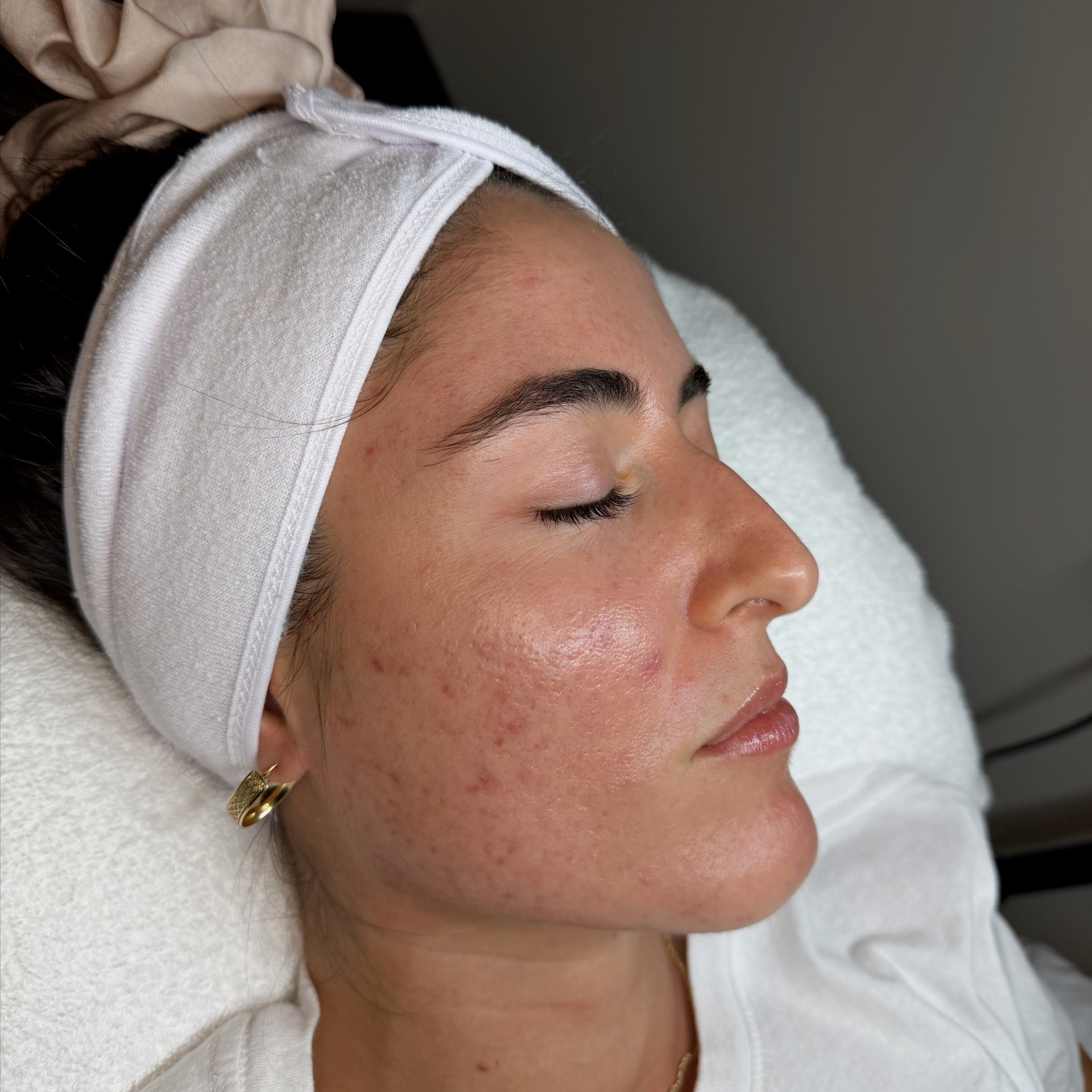 Clear Skin Program Consult