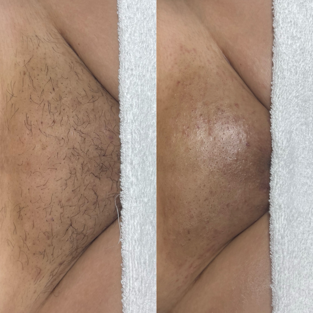 Brazilian Wax at A.ESTHETICS in Soledad, CA