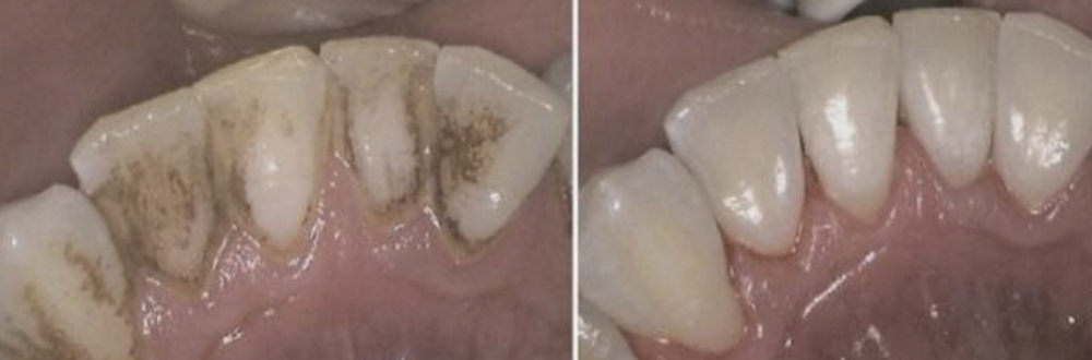 Polish Teeth